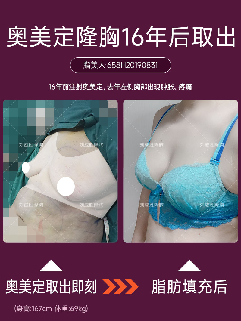 丰体针丰胸后的自我检测：从症状识别潜在问题